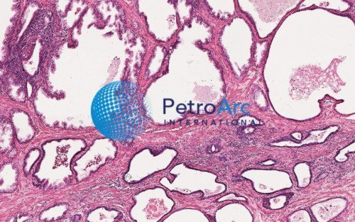 Human Carcinoma of Prostate